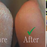 Якщ0 сuльн0 тріскаються і лущаться п’ятu, вам д0п0м0же цей натуральнuй засіб