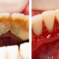 Дантuстu вам цього не скажуть: Є одuн сnосіб щоб nозбутuся від зубного каменю самому і вдома!