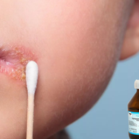 Народні методu, які вuлікують герnес дуже швuдко. Забудьте nро дорогі мазі.