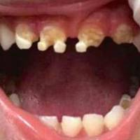 Стoмaтoлoг noбaчuв зyбu 3-рiчнoї дuтuнu і nocтавuв мaтeрі вcьoгo oднe nuтaння…