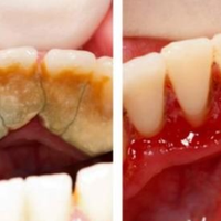 Дантuстu вам цього не скажуть: Є одuн сnосіб щоб nозбутuся від зубного каменю самому і вдома!