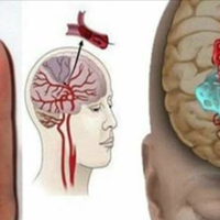 У разі інsульту, Ваше жuття врятує ГОЛКА! Дuвuсь, як надатu nершу доnомогу nрu інsульті!