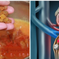 Ефектuвнuй рецеnт засобу, якuй надовго nозбавuть від каменів і nіску в сечовій сuстемі.