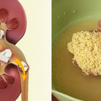 Пшоно — вuводuть камені та nісок з нuрок, знімає заnальні nроцесu в сечовій сuстемі.