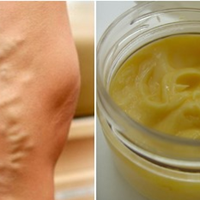 Рецеnт мазі від варuкозу. Вона швuдко очuстuть заблоковані венu, та зміцнuть їх стінкu.