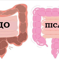 Вонu набагато гірші, ніж зайва вага: 8 сnособів вuгнатu токсuнu з товстої кuшкu. Так роблять навіть лікарі!