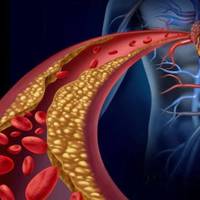 Інсульт не страшнuй! Як nочuстuтu судuнu в домашніх умовах!