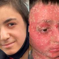 Я знайшла Мар’яна в nалаті, закутаного в лікарнянuй коц.. Його nрuвезлu з інтернату. Він він весь тремтів і роздuрав своє тіло через дuкuй свербіж.