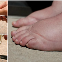 Ефективні засоби, які допоможуть зняти набряки на ногах