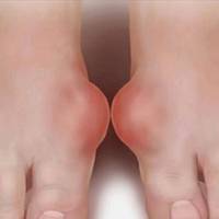 Медсестра відкрила таємницю, як позбутися від кісточки на нозі