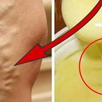 Бабусин рецепт чарівної мазі від варикозного розширення вен! “Просто дивo якeсь!»