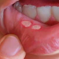 Стоматит ротової порожнини! Ось як позбутися від нього народним методом!