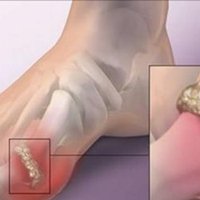 Болі в суглобах, артрит, подагра: 7 найпотужніших продуктів для усунення!