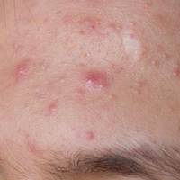 Аспірин відмінний засіб від прищів, лупи і мозолів. Чому я не знала цього раніше?