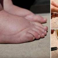 Смачний чай для боротьби з затримкою рідини, набряками, діабетом та зайвою вагою