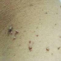 Позбудься папілом і бородавок назавжди! Цей засіб є у кожного вдома!