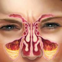 Всього лише дві пляшечки пеніциліну — і ви забудете про гайморит назавжди!