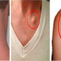 Швидке і просте видалення жирової тканини абсолютно природним способом!