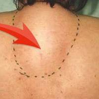 Простий засіб, який витягне солі з шийного відділу і позбавить остеохондрозу!