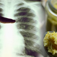 Натуральний та дієвий засіб лікування пневмонії. Знімає запальний процес, та полегшує кашель