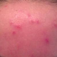 Ці таблетки є в кожній аптечці, і вони чудово допомагають від прищів, лупи і мозолів!