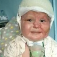 Помер дворічний малюк, який обгорів у зачиненій машині: “Артемко мучився 5 місяців”