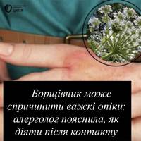Борщівник може спричинити важкі опіки: алерголог пояснила, як діяти після контакту
